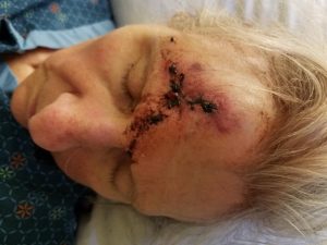 head injury from falling out of a wheelchair forward